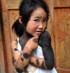 Bệnh lạ: Bé gái mọc lông "thú" đầy người